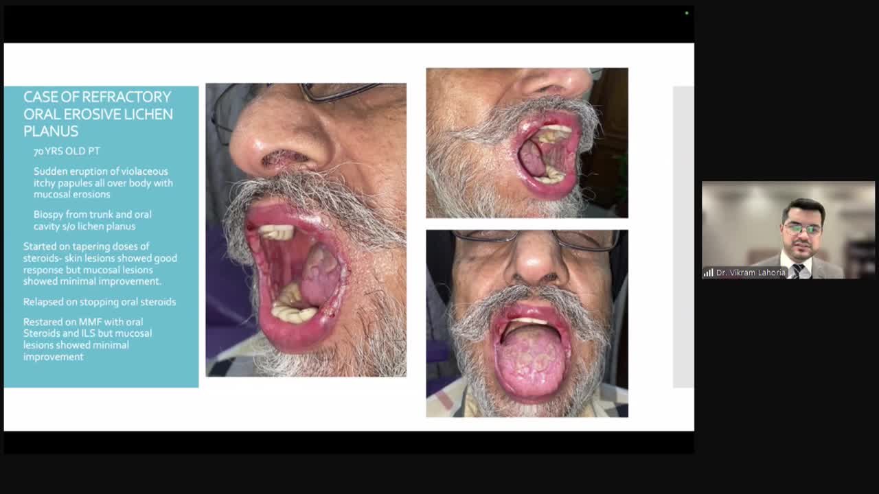 Oral Tofacitinib in Dermatology: The Big Picture Session – 4 Image