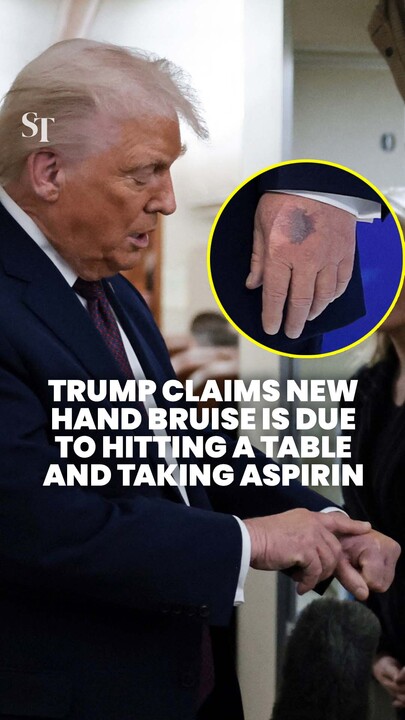 Trump’s new hand bruise: From hitting a table and taking aspirin