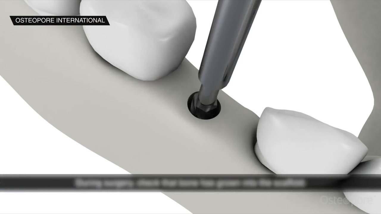 New 3D dental plug may help patients save up to S2,000 Video CNA